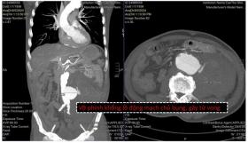  Cảnh báo tử vong vì vỡ túi phình động mạch chủ bụng 