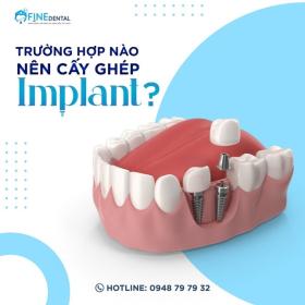  Công nghệ cấy ghép Implant hiện đại tại Nha khoa Fine Dental 