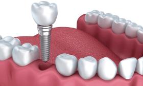  Công nghệ cấy ghép Implant hiện đại tại Nha khoa Fine Dental 